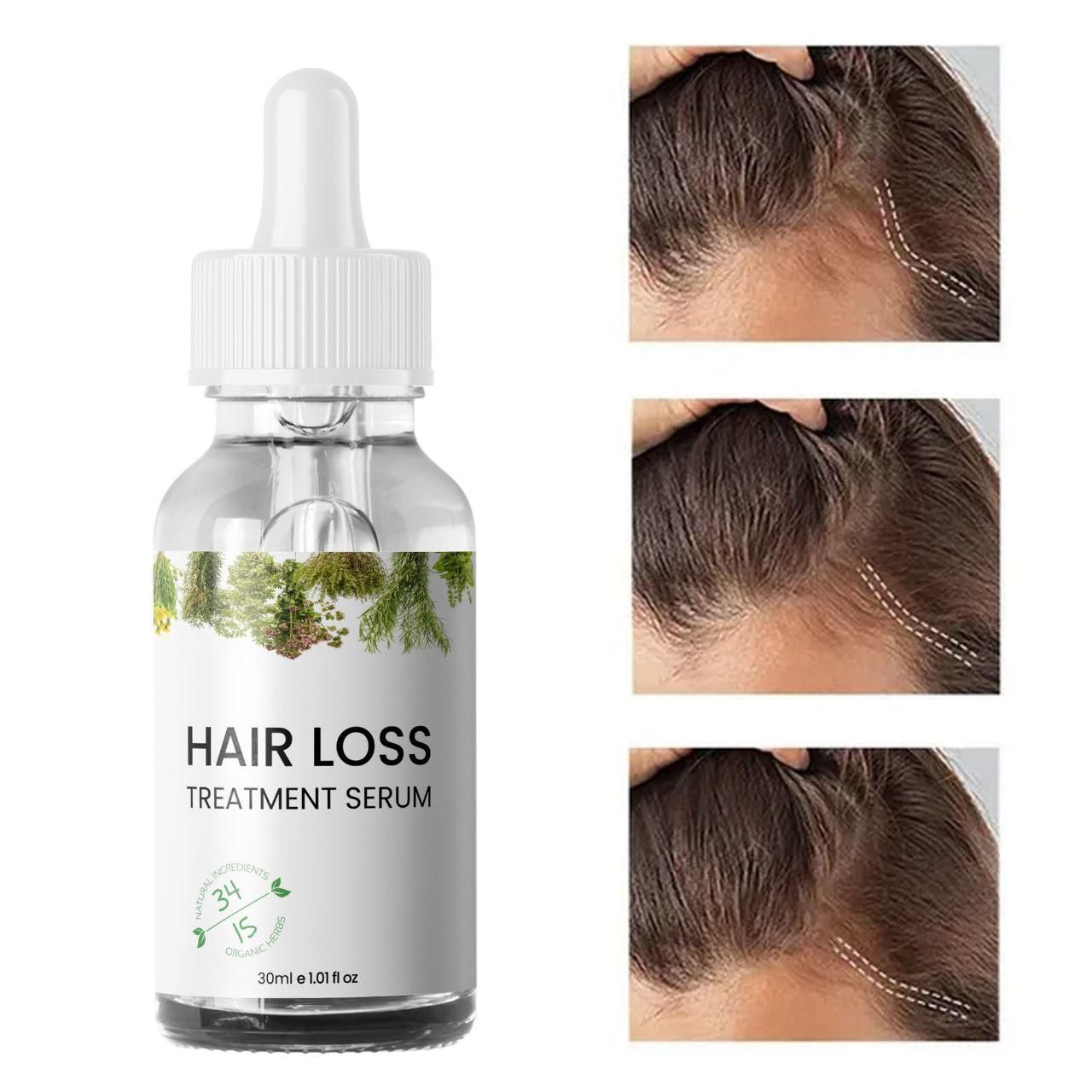 Hair Loss Treatment Serum 30Ml (Pack Of 1)